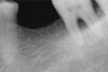 molar implant