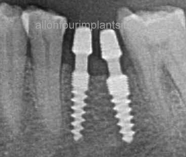 molar implant