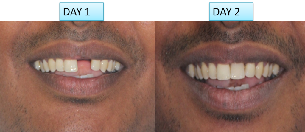 Immediate dental implant cost India