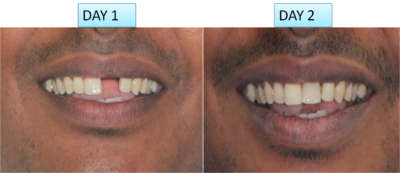 single tooth implant cost in India, Chennai