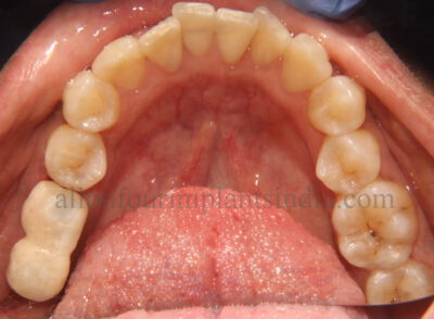 FIXED TEETH DENTAL IMPLANTS