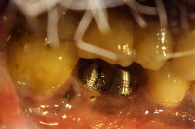 molar implant