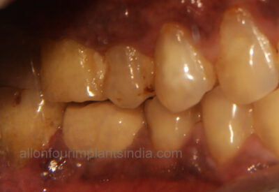 molar implant