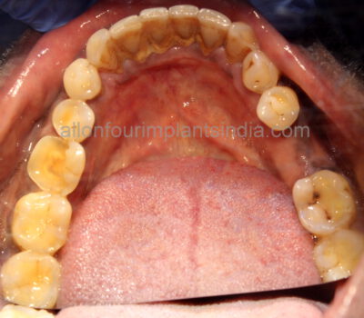 molar implant