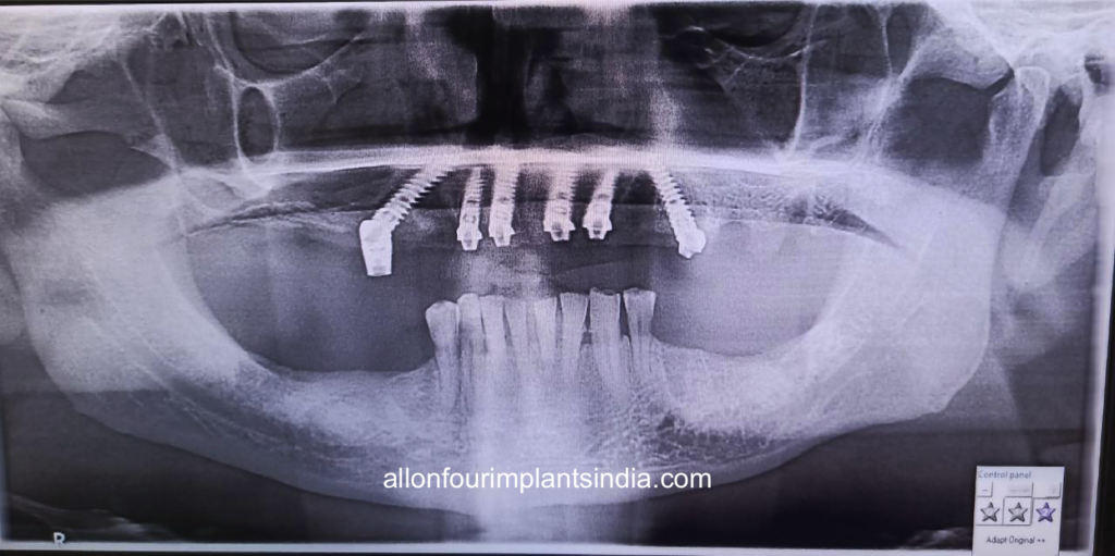 allon 6 dental implants for full teeth replacement in India