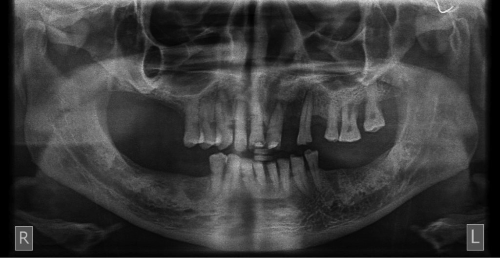 allon 6 dental implants for full teeth replacement in India