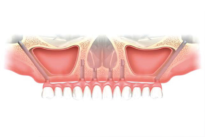 zygoma dental implant cost India
