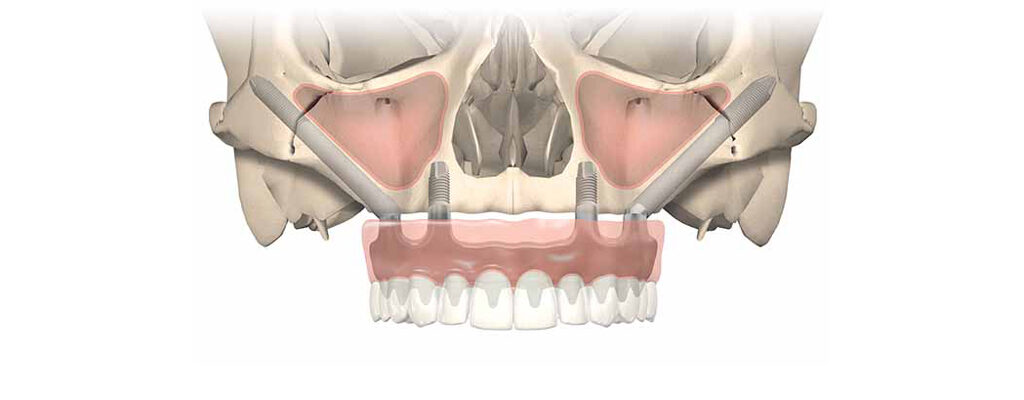 zygoma dental implant cost India, Chennai