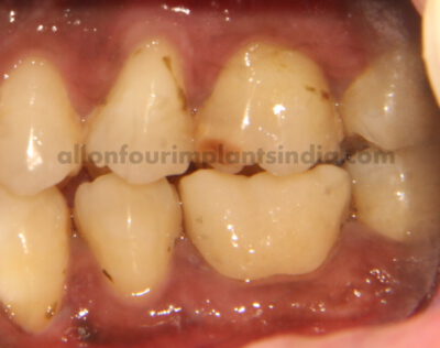 Zirconia crown in a day