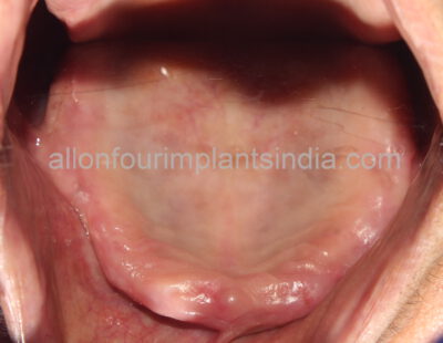 all on 4 dental implant in India