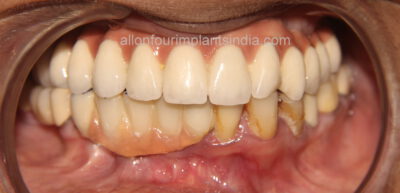 Upper full teeth replacement with dental implant
