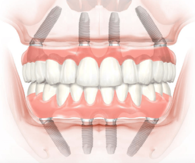 Allon four dental implants in India