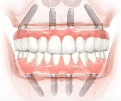 allon four implant India