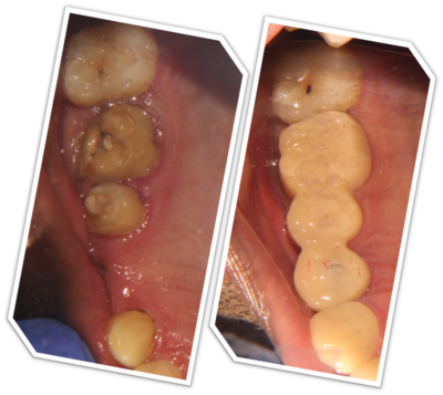dental implant for multiple teeth replacement in India