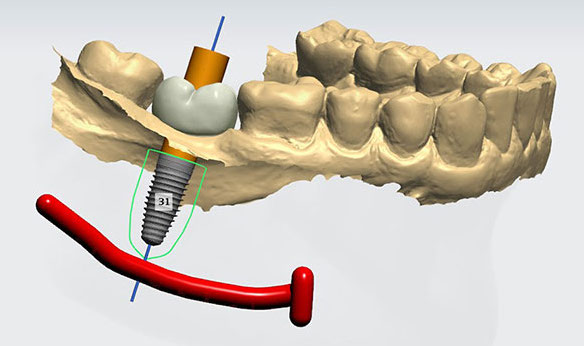 guided dental implants in India