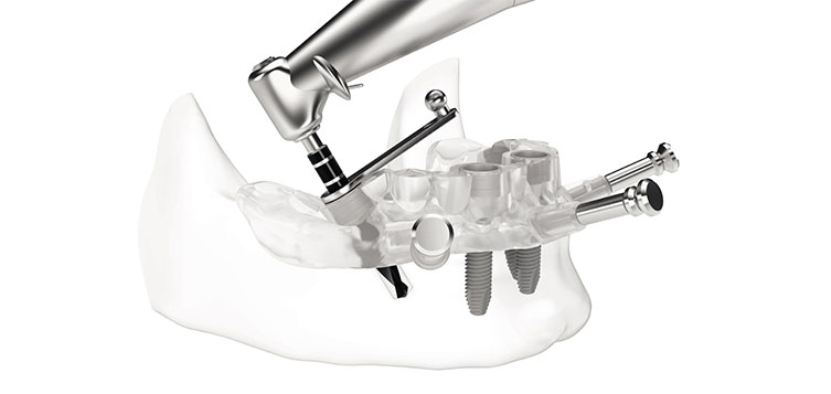 dental implant surgical guides in India