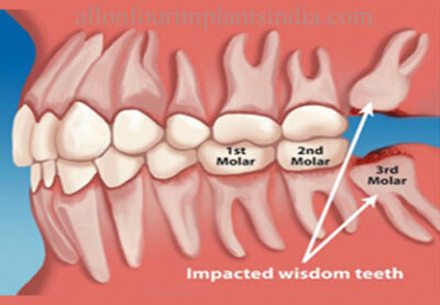 cost of 4 wisdom teeth removal