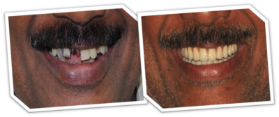 allon 4 dental implants in India, Chennai