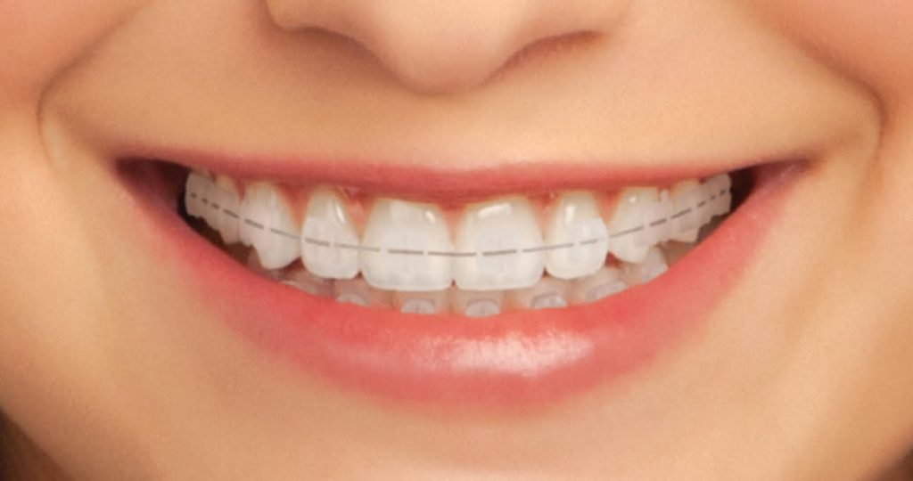 Ceramic teeth braces India