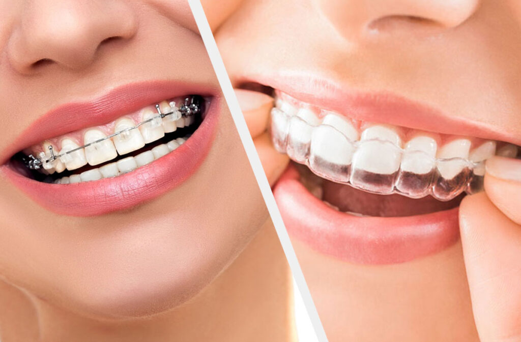 Invisalign clear aligners cost in India