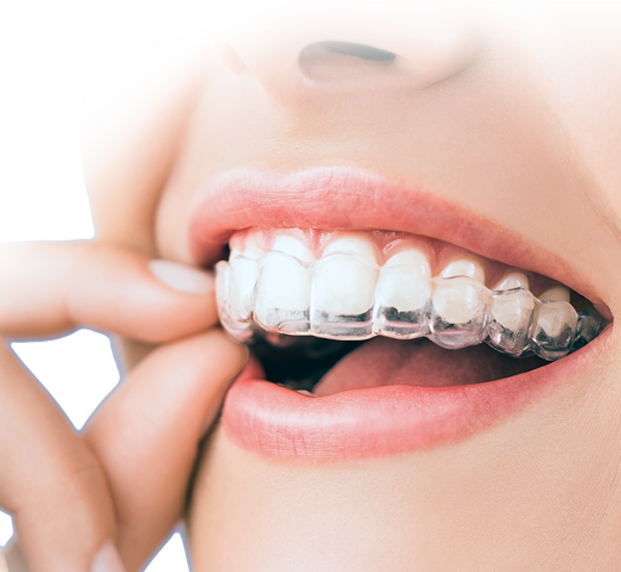 invisalign clear braces in India