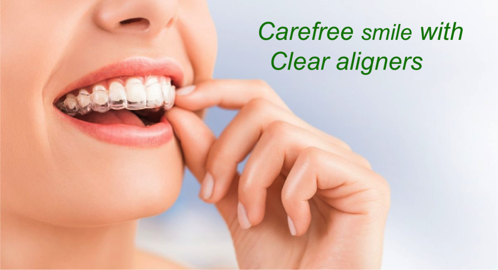 invisalign clear aligners cost in India