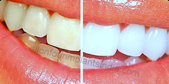 Teeth Whitening Cost In Chennai India