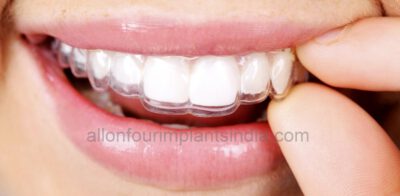 Braces treatment cost in India