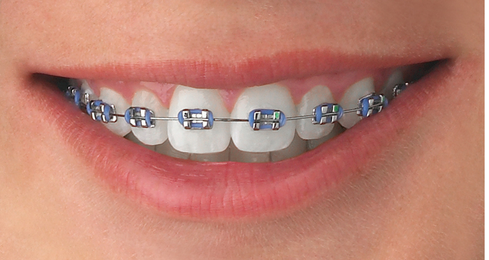 metal braces in India