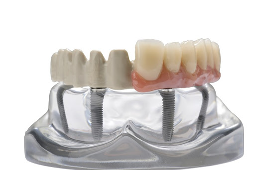 tooth implant cost in India