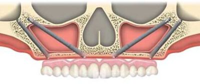 cost of quad zygoma implants in India, Chennai