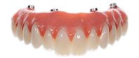 teeth-replacement-using-acrylic-india-chennai