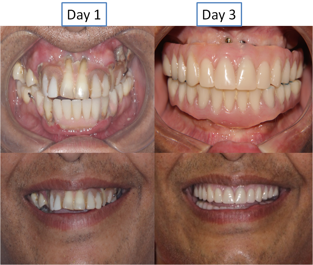 Full Mouth Dental Implants