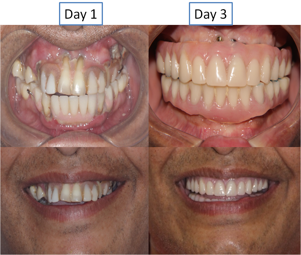 Full Mouth Replacement 1 2 