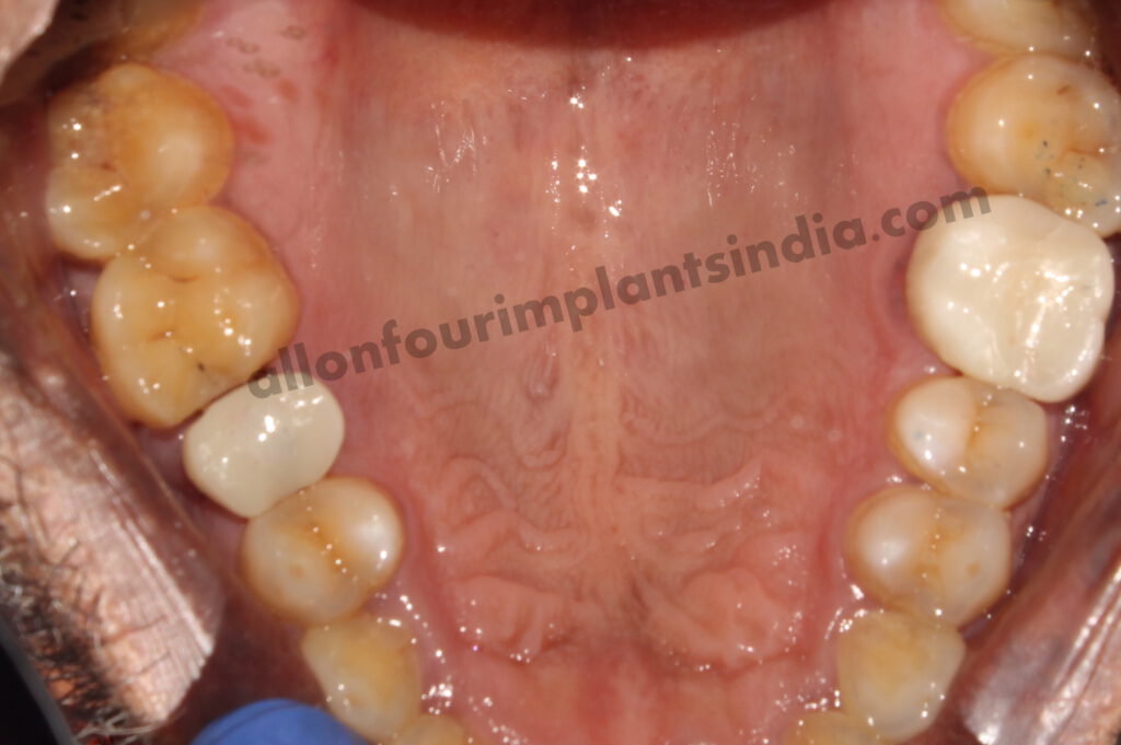 Zirconia crown cost in India