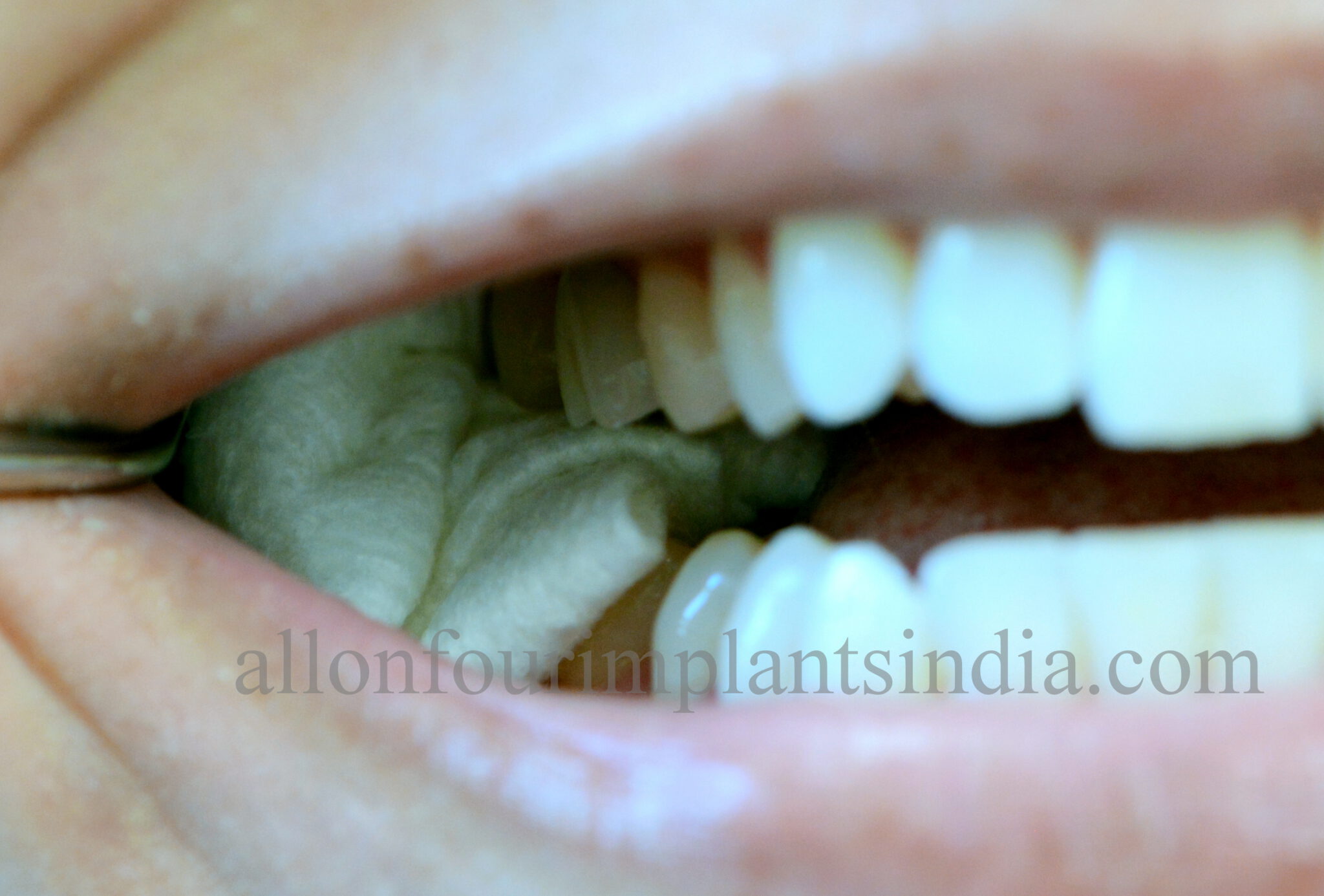 Do’s and Don’ts after wisdom tooth removal,Chennai.